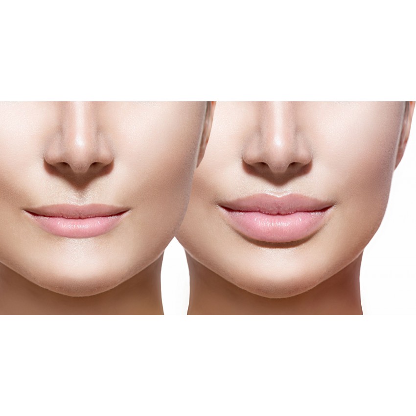 How Much Do Lip Fillers Cost? Understanding Prices and Treatment Factors